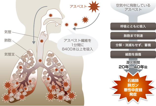 石綿肺の長期展望と合併症